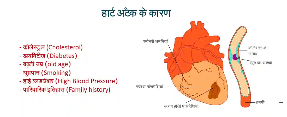 Causes of Heart Attack in Hindi